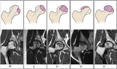 A nomogram for predicting the probability of femoral head collapse in convalescent SARS patients with glucocorticoid-induced osteonecrosis of the femoral head: an 18-year population-based retrospective cohort study